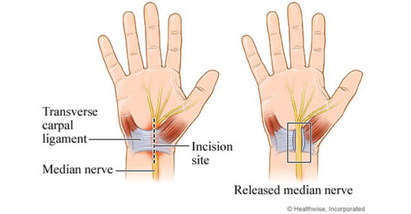 Carpal Tunnel Surgery Diagram